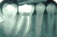 endodoncia